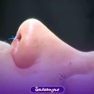 نمونه کار عمل بینی دکتر حمیرا رشدی 3