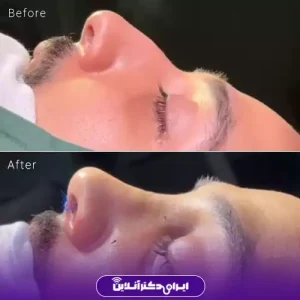نمونه کار عمل بینی دکتر حمیرا رشدی 4