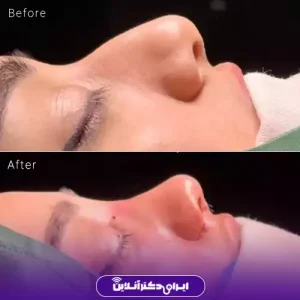 نمونه کار عمل بینی دکتر حمیرا رشدی 5
