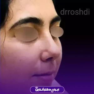 نمونه کار عمل بینی دکتر حمیرا رشدی 8