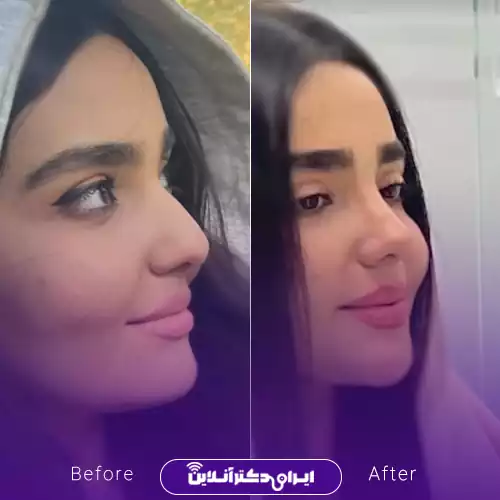 بهترین جراح بینی استخوانی در تهران + لیست 8 پزشک متخصص 96 نمونه جراحی بینی استخوانی دکتر روزینا بشارتی زاده 1