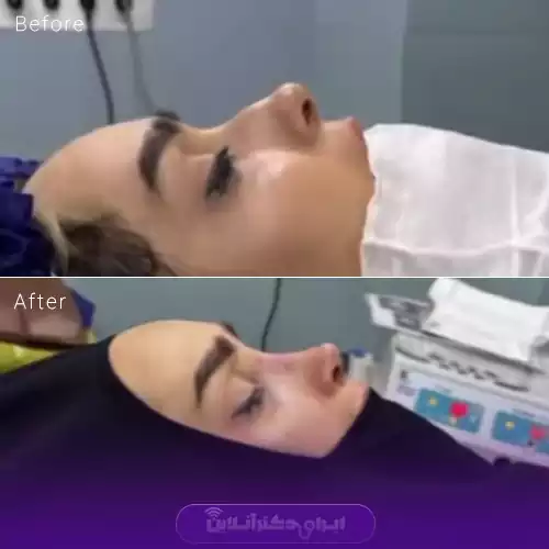 بهترین جراح بینی استخوانی در تهران + لیست 8 پزشک متخصص 128 نمونه جراحی بینی استخوانی دکتر امین بختیاری 2