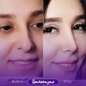 نمونه کار عمل بینی دکتر امیر نیازی 1