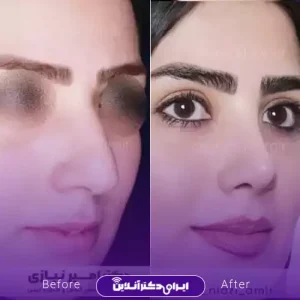 نمونه کار عمل بینی دکتر امیر نیازی 2