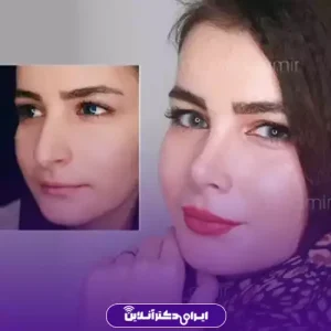 نمونه کار عمل بینی دکتر امیر نیازی 3