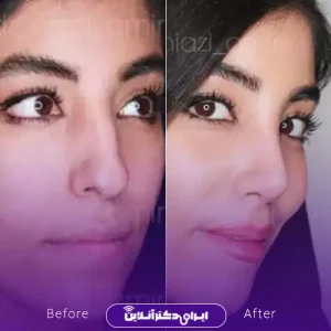 نمونه کار عمل بینی دکتر امیر نیازی 4