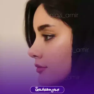 نمونه کار عمل بینی دکتر امیر نیازی 9