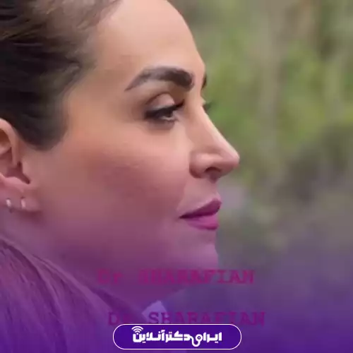 نمونه کار عمل بینی دکتر آرش شرفیان 1