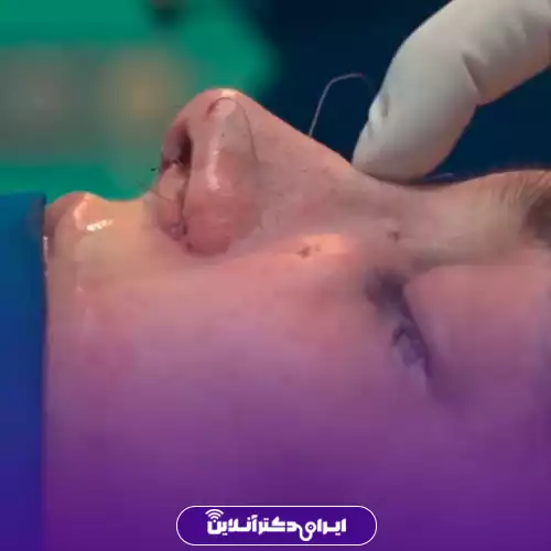 نمونه کار عمل بینی دکتر آرش شرفیان 4