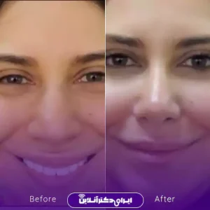 نمونه کار عمل بینی دکتر شاهین فتح سامی 3