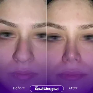 نمونه کار عمل بینی دکتر شاهین فتح سامی 4