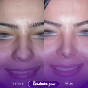 نمونه کار عمل بینی دکتر شاهین فتح سامی 5
