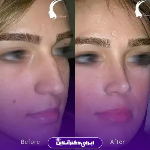 نمونه کار عمل بینی دکتر شاهین فتح سامی 6