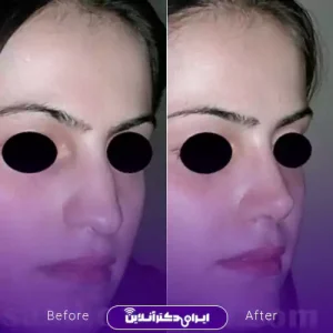 نمونه کار عمل بینی دکتر شاهین فتح سامی 7