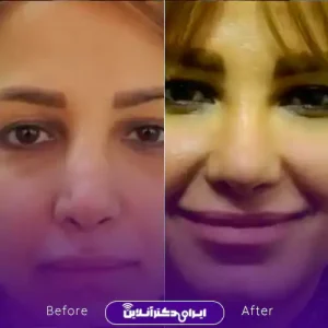 نمونه کار عمل بینی دکتر شاهین فتح سامی 8