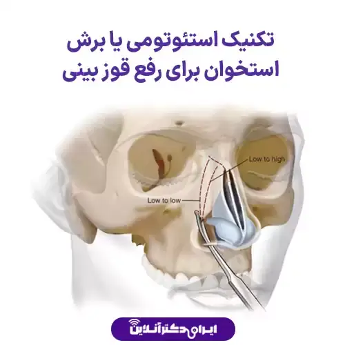 عمل بینی قوزدار و عقابی؛ راهنمای جامع جراحی بینی قوزدار 5 استئوتومی یا برش استخوان
