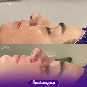 نمونه کار عمل بینی دکتر رضا خورشیدی خیاوی 1