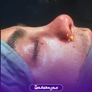 نمونه کار عمل بینی دکتر رضا خورشیدی خیاوی 2