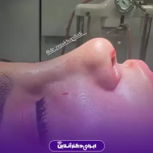 نمونه کار عمل بینی دکتر رضا خورشیدی خیاوی 9