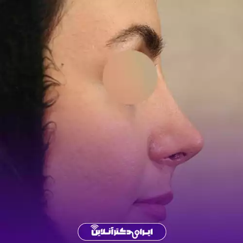 بهترین جراح بینی فانتزی در تهران (لیست 10 پزشک برتر + نمونه کار) 147 نمونه کار جراحی بینی فانتزی دکتر شهریار یحیوی 1