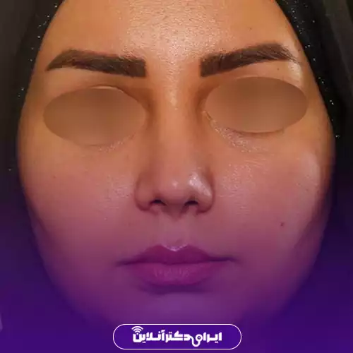 بهترین جراح بینی فانتزی در تهران (لیست 10 پزشک برتر + نمونه کار) 148 نمونه کار جراحی بینی فانتزی دکتر شهریار یحیوی 2