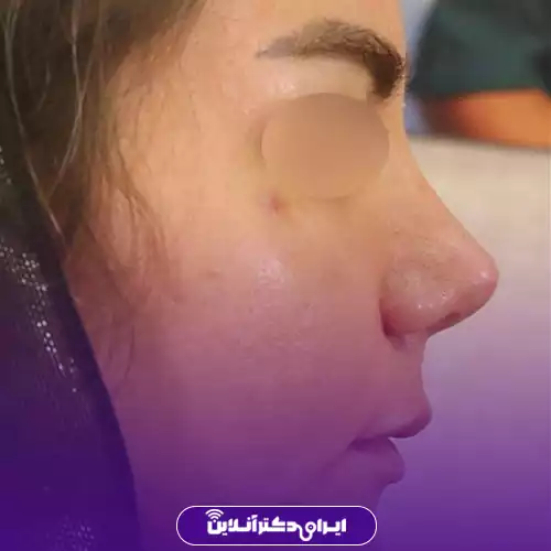 بهترین جراح بینی فانتزی در تهران (لیست 10 پزشک برتر + نمونه کار) 149 نمونه کار جراحی بینی فانتزی دکتر شهریار یحیوی 3