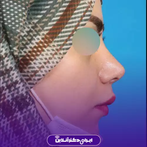 بهترین جراح بینی فانتزی در تهران (لیست 10 پزشک برتر + نمونه کار) 150 نمونه کار جراحی بینی فانتزی دکتر شهریار یحیوی 4