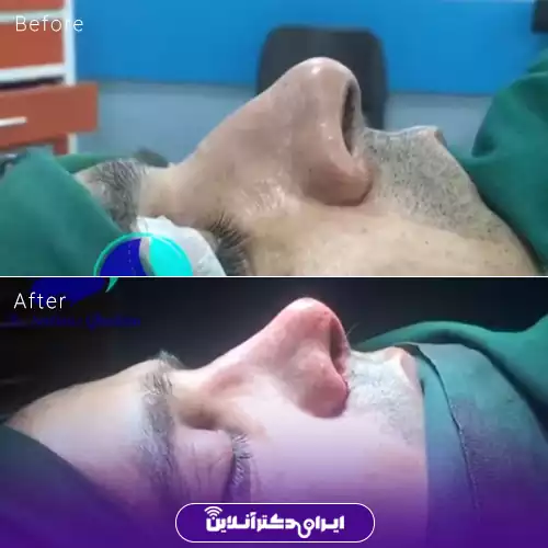 بهترین جراح بینی استخوانی در تهران + لیست 8 پزشک متخصص 92 نمونه عمل بینی استخوانی دکتر سولماز قربانی 1