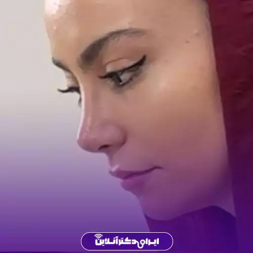 بهترین جراح بینی استخوانی در تهران + لیست 8 پزشک متخصص 124 نمونه کار عمل بینی استخوانی دکتر آرزو خوانسارینیا 3