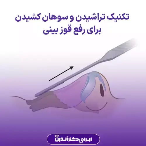 عمل بینی قوزدار و عقابی؛ راهنمای جامع جراحی بینی قوزدار 4 تراشیدن و سوهان کشیدن