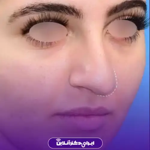 عمل بینی قوزدار و عقابی؛ راهنمای جامع جراحی بینی قوزدار 2 قوز غضروفی