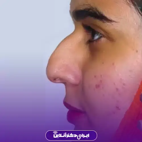 عمل بینی قوزدار و عقابی؛ راهنمای جامع جراحی بینی قوزدار 1 قوز بینی چیست و از کجا میآید؟