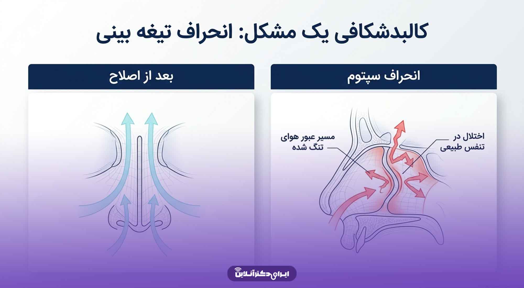 عمل سپتوپلاستی چیست؟ بررسی چگونگی و افراد واجد شرایط سپتوپلاستی 3 چرا عمل سپتوپلاستی انجام میشود