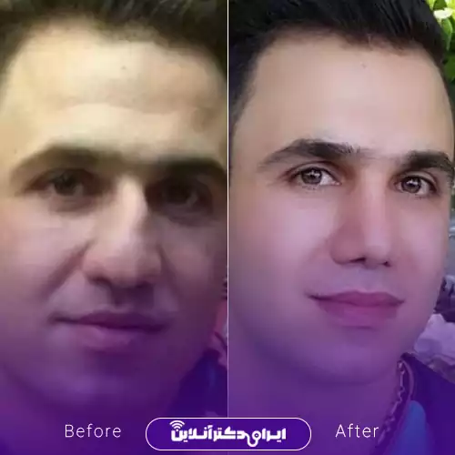 نمونه کار قبل و بعد جراحی بینی گوشتی دکتر حسینی 1
