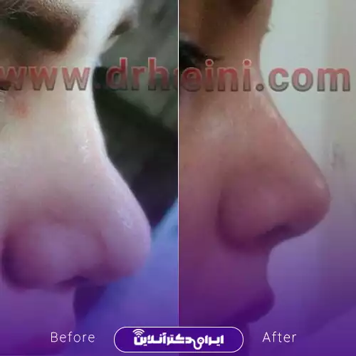 نمونه کار قبل و بعد جراحی بینی گوشتی دکتر حسینی 2