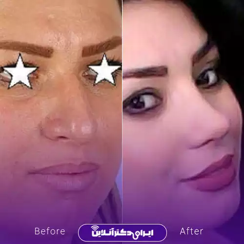 نمونه کار قبل و بعد جراحی بینی گوشتی دکتر حسینی 3