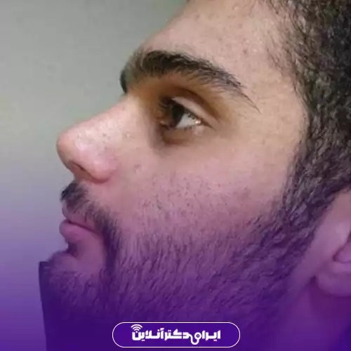 نمونه کار قبل و بعد جراحی بینی گوشتی دکتر حسینی 4