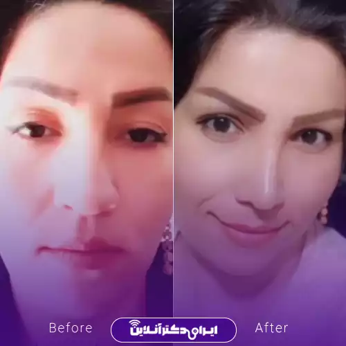 نمونه کار قبل و بعد عمل بینی گوشتی دکتر صادق زاده 1