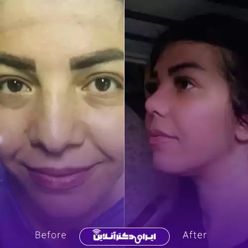 نمونه کار قبل و بعد عمل بینی گوشتی دکتر صادق زاده 2