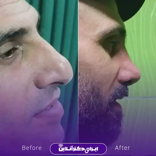 نمونه کار قبل و بعد عمل بینی گوشتی دکتر صادق زاده 3