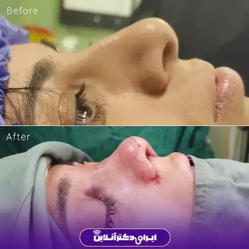 نمونه کار قبل و بعد عمل بینی گوشتی دکتر صادق زاده 4