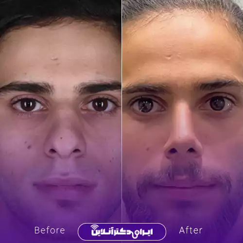 نمونه کار قبل و بعد جراحی بینی گوشتی دکتر محمد طالب‌زاده 1
