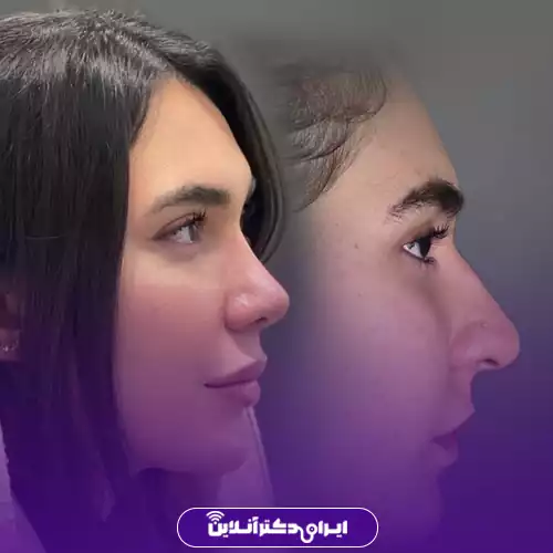نمونه کار قبل و بعد جراحی بینی گوشتی دکتر محمد طالب‌زاده 2