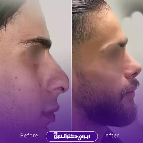نمونه کار قبل و بعد جراحی بینی گوشتی دکتر محمد طالب‌زاده 3