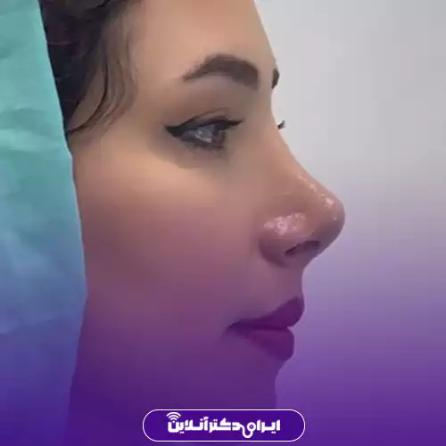 نمونه کار قبل و بعد جراحی بینی گوشتی دکتر محمد طالب‌زاده 4