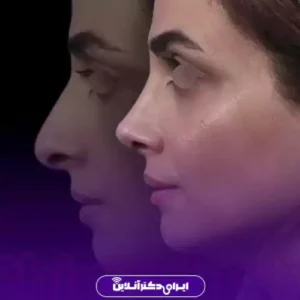 نمونه کار عمل بینی دکتر علیرضا مجلسی 1