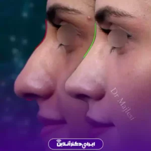 نمونه کار عمل بینی دکتر علیرضا مجلسی 2