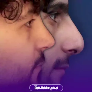 نمونه کار عمل بینی دکتر علیرضا مجلسی 3