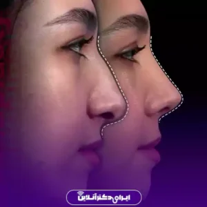 نمونه کار عمل بینی دکتر علیرضا مجلسی 4