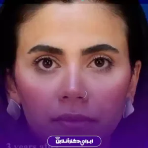 نمونه کار عمل بینی دکتر علیرضا مجلسی 6